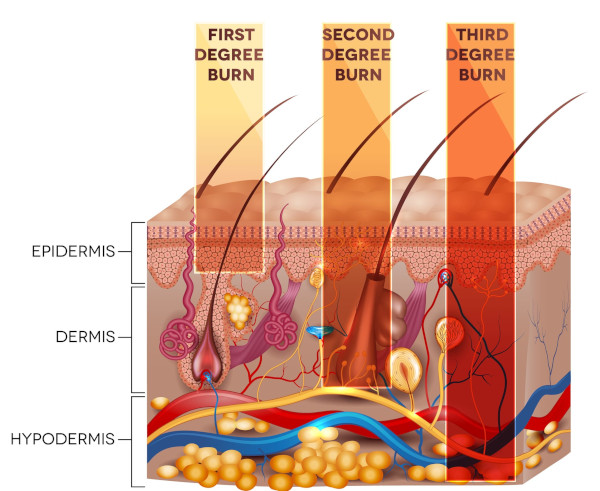 firefighting-course-skin-burn-classification-50132291