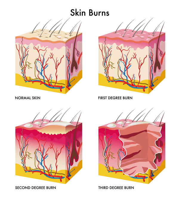 first-aid-training-burn-infographic